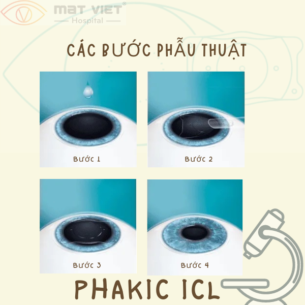 Phakic Icl Gi I Ph P Cho M T C Kh C X Cao B Nh Vi N M T Vi T