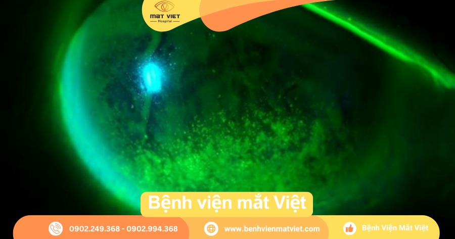 Hình: Giác mạc nhuộm fluorescein dương tính ở 1/3 dưới – thứ phát do hở mi hoặc quặm mi dưới hoặc viêm bờ mi mạn tính.