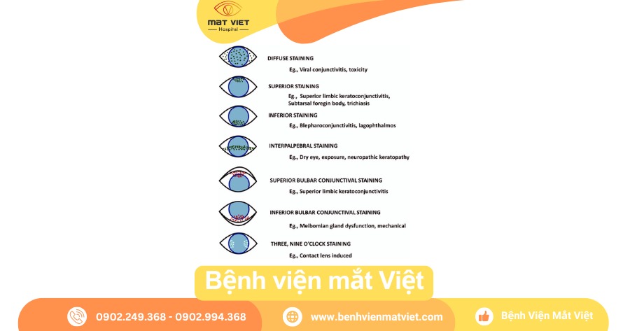 Hình: Phân bố các PEE và gợi ý căn nguyên