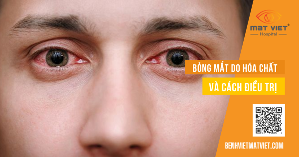 Bong Mat Hoa Chat 1200x630