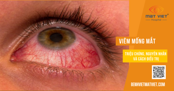 ViÊm MỐng MẮt