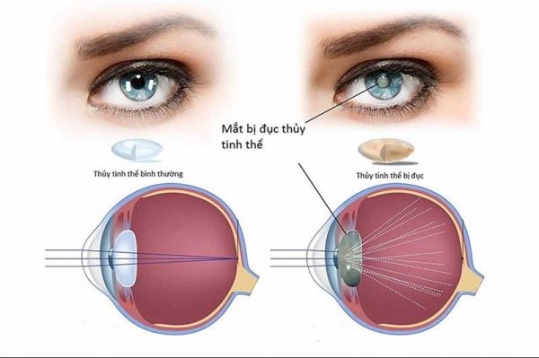 VIÊM MỐNG MẮT: TRIỆU CHỨNG, NGUYÊN NHÂN VÀ CÁCH ĐIỀU TRỊ