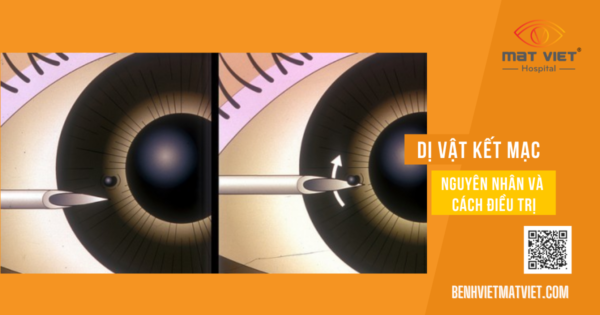 Di vat ket mac-01
