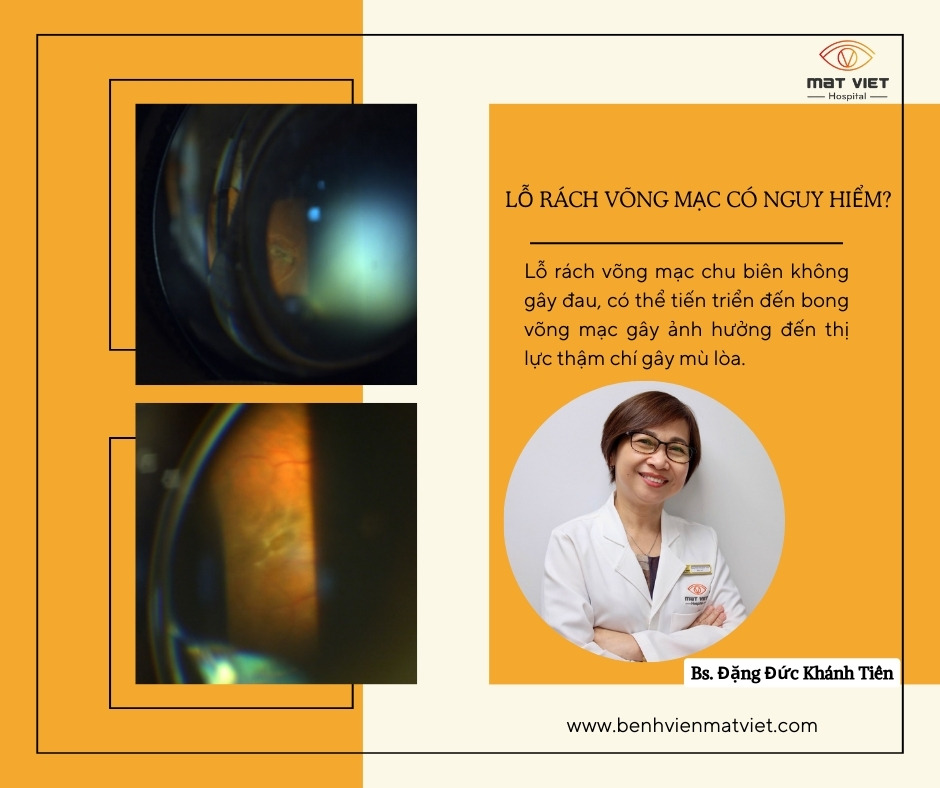 Lỗ rách võng mạc - Rách võng mạc có nguy hiểm không | Bệnh Viện Mắt Việt