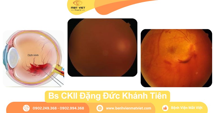 Hình: Xuất huyết trong buồng dịch kính.