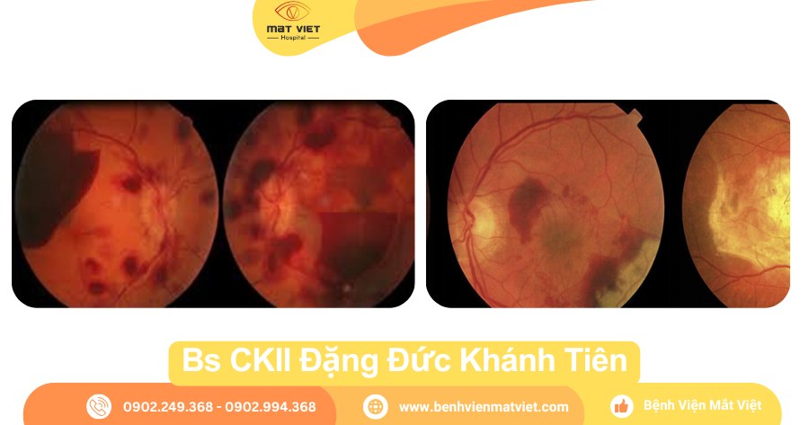 Hình: Hội chứng Terson và Thoái hóa hoàng điểm tuổi già (AMD).