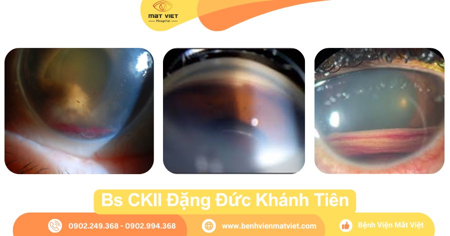 Hình: Tăng nhãn áp tế bào ma (Ghost cell Glaucoma).