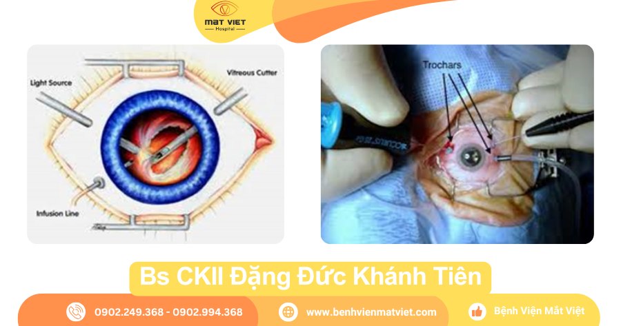 Hình: Phẫu thuật cắt dịch kính