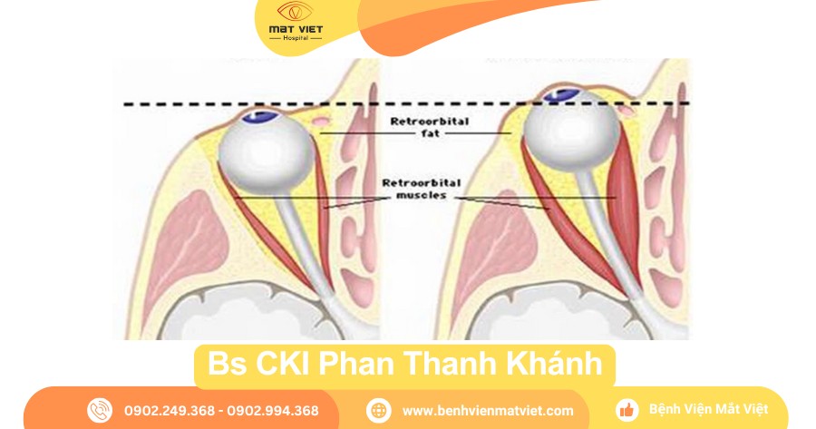 Các mức độ lồi mắt