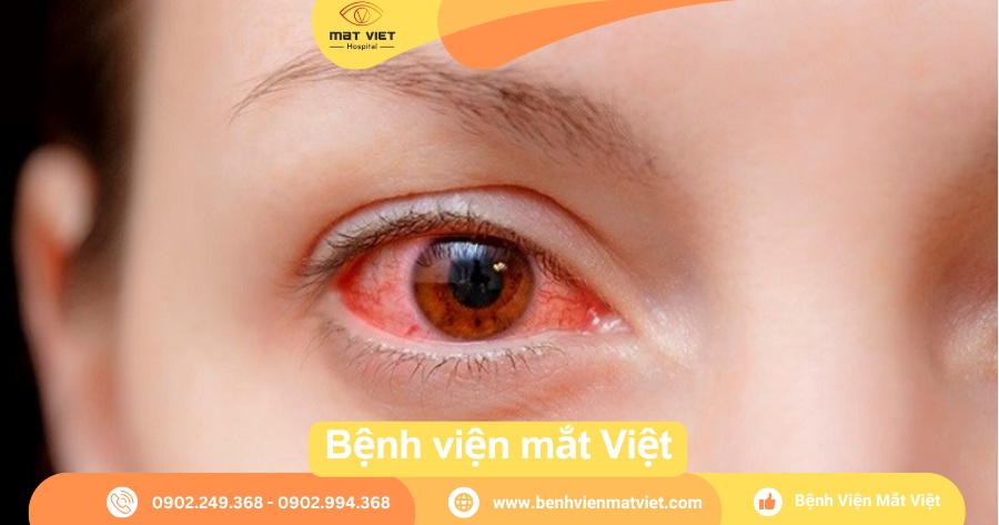 Hình: Phấn hoa, bụi và bệnh viêm kết mạc mùa xuân.