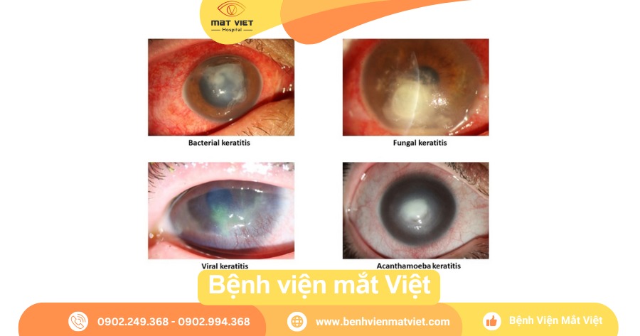 Các dạng viêm giác mạc
