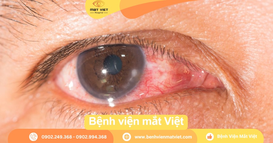 Mắt viêm giác mạc