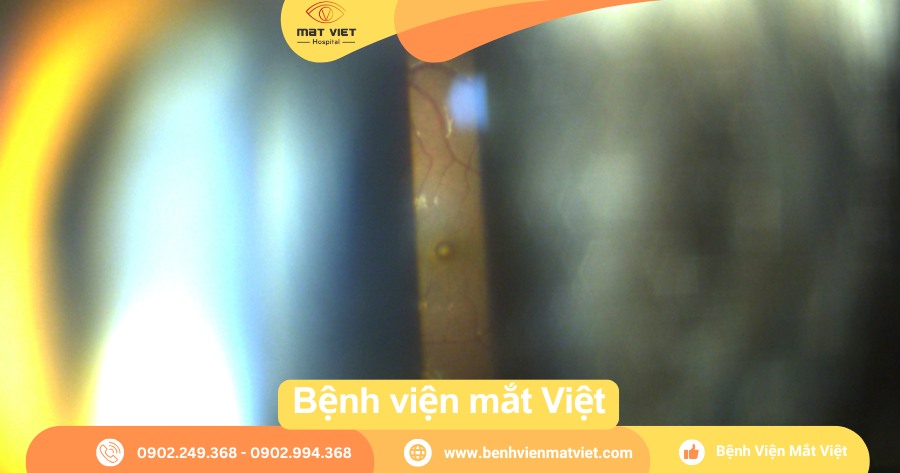 Hình ảnh hoàng điểm bị tổn thương do laser (Nguồn: Bệnh viện mắt Việt)