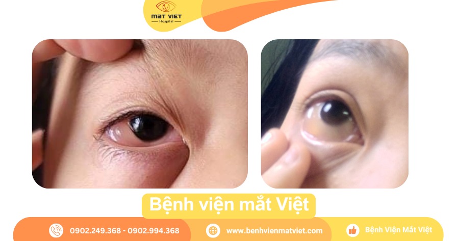 “Sưng tròng trắng” sau khi dụi mắt.