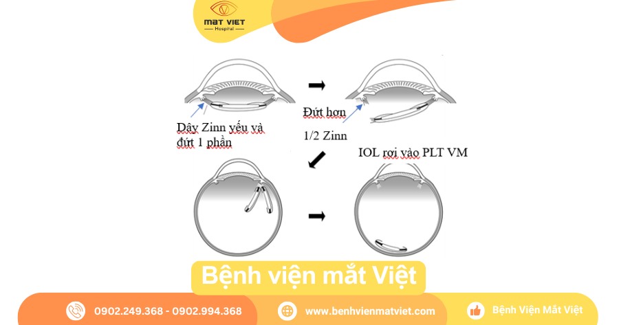 Yếu hoặc đứt dây Zinn, IOL di chuyển ra khỏi vị trí bình thường trong mắt.