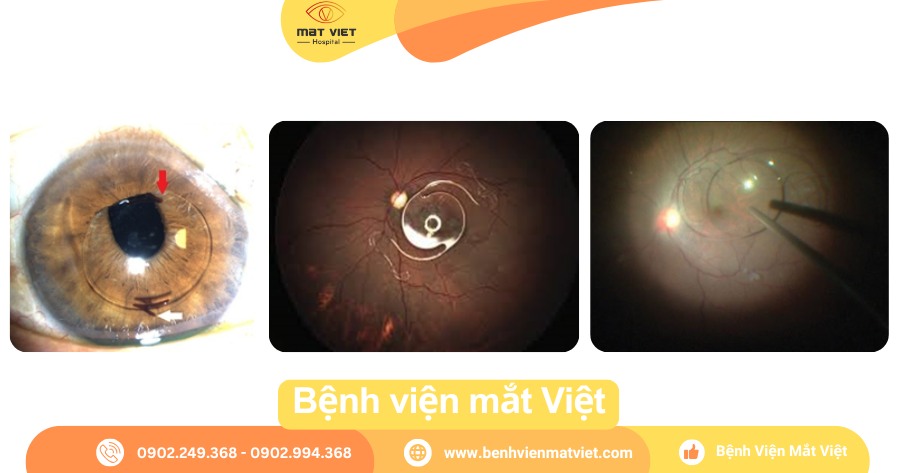 Sa IOL ra tiền phòng và sa IOL ra phía sau buồng dịch kính.