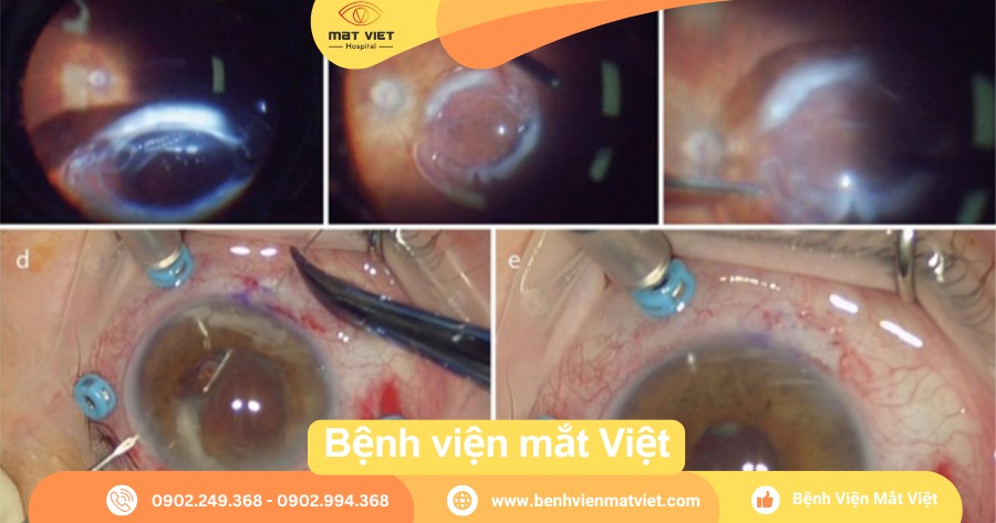 Cắt dịch kính – lấy IOL cũ – cố định IOL mới