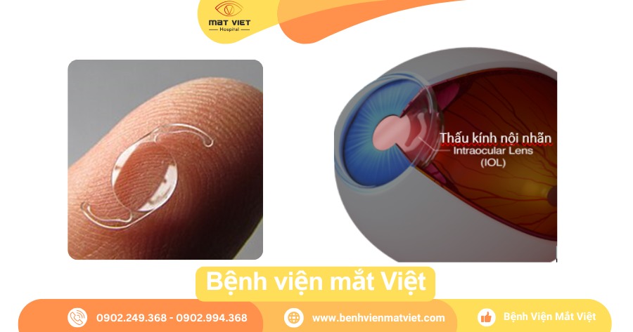 Vị trí bình thường của IOL sau phẫu thuật Phaco thay thế đục thủy tinh thể.