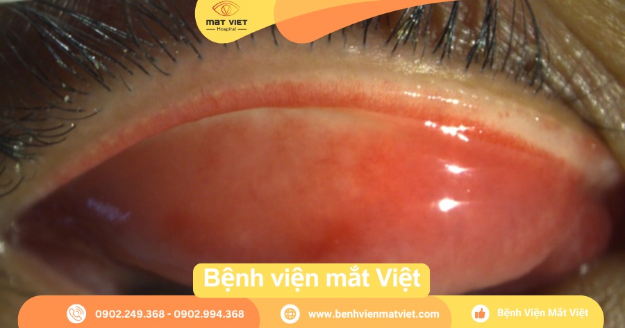Giác mức mức độ nặng hơn, sẽ có màu trắng đục, bám lên mặt trong kết mạc mi trên (Nguồn: Bệnh viện mắt Việt)