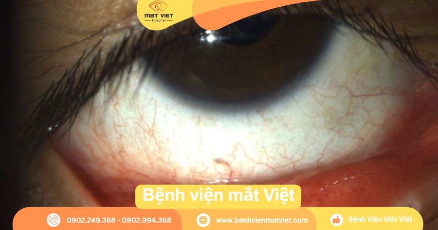 Giác mạc mi dưới kết mạc (Nguồn: Bệnh viện mắt Việt)