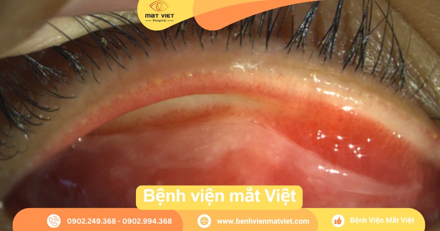 Giả mạc được bóc ra nhẹ nhàng sau khi nhỏ thuốc tê tại chỗ (Nguồn: Bệnh viện mắt Việt)