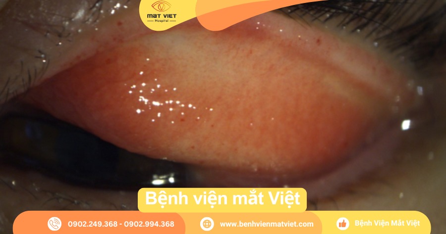 Hình 1: Khi ở mức độ nhẹ, giả mạc còn trong suốt, bám lên mặt trong kết mạc mi trên (Nguồn: Bệnh viện mắt Việt)