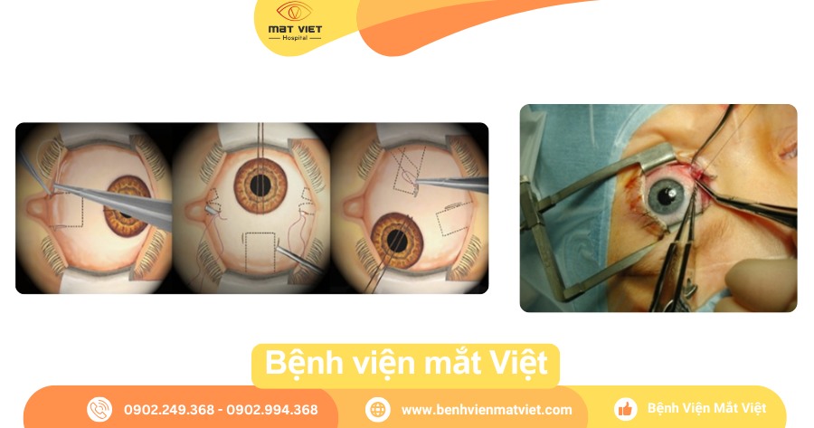 Phẫu thuật lé là phẫu thuật ngoại nhãn.