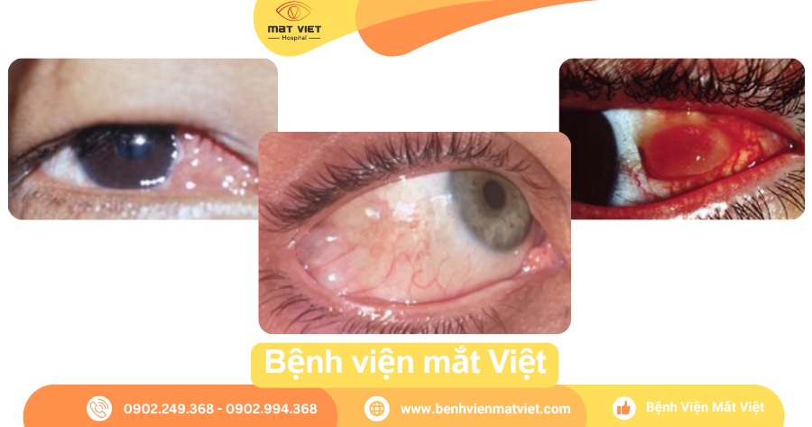 Nang nước kết mạc – u hạt kết mạc sau phẫu thuật chỉnh lé.