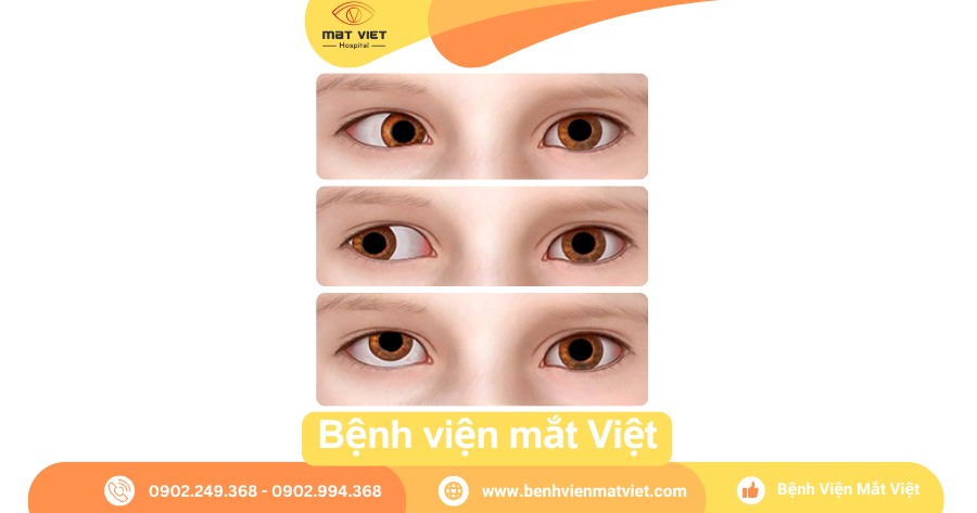 Mắt lé