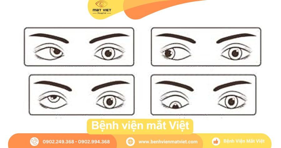 Các kiểu lé: lé trong, lé ngoài, lé đứng.