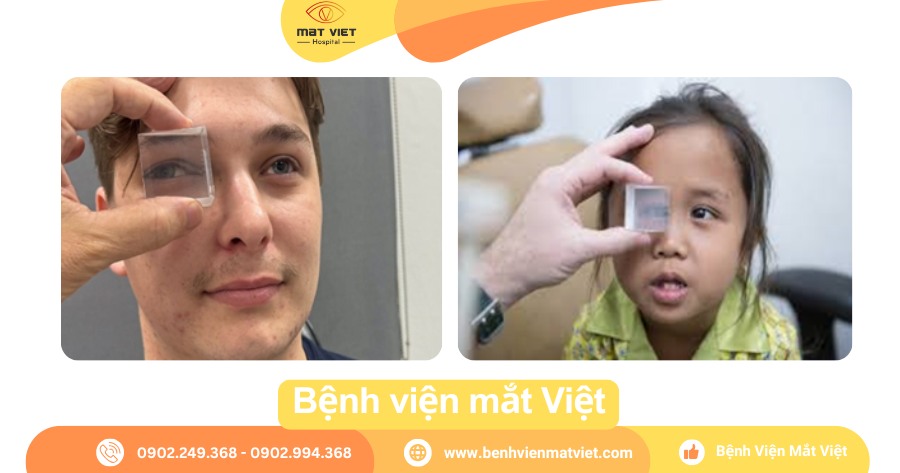 PP Krimky: Đo góc lé, loại trừ giả lé.