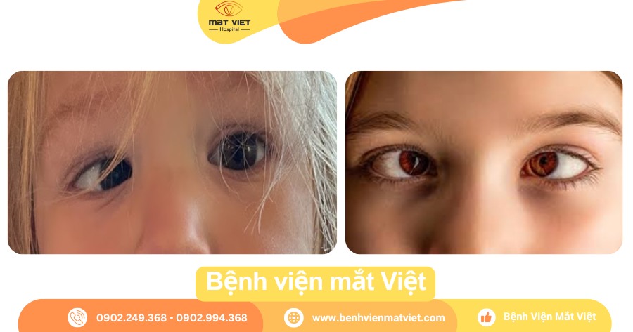 Mắt lé.