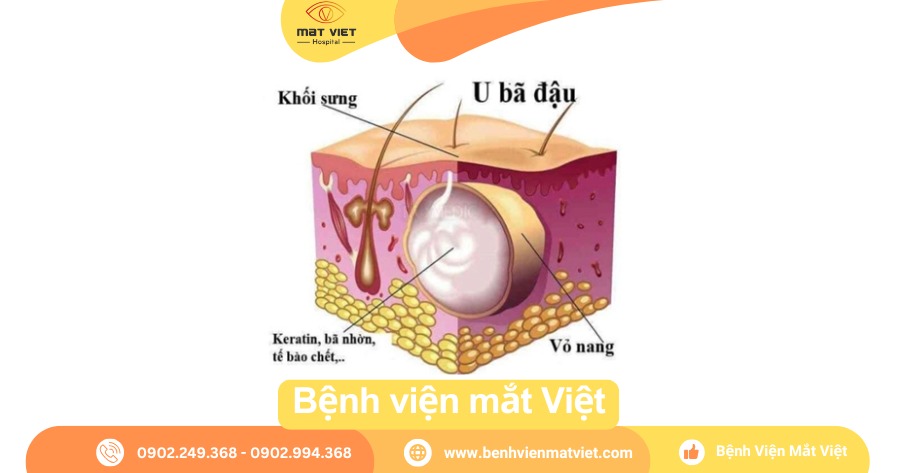 Sự hình thành nang bã đậu dưới da.