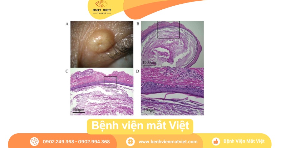U nang bã và giải phẫu mô học của nang.