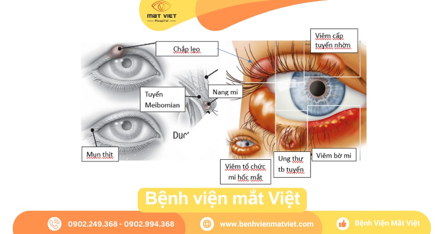 Chẩn đoán phân biệt với nang bã đậu mi mắt