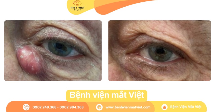 Mi mắt trước và sau khi cắt bỏ u nang bã đậu