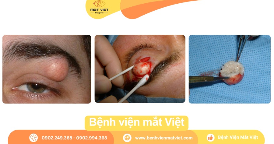 Cắt lấy trọn nang bã đậu mi mắt