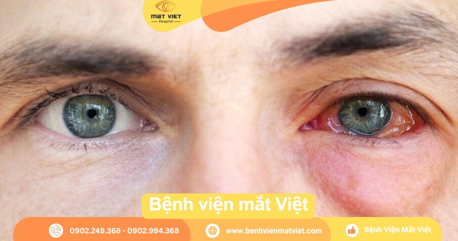 Các biểu hiện khi bị dầu nóng bắn vào mắt