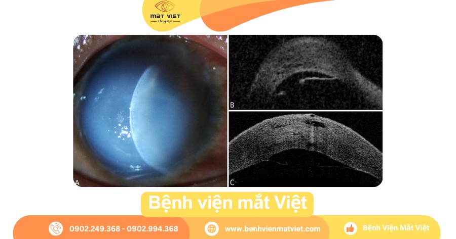 Biến chứng acute hydrops của giác mạc chóp.