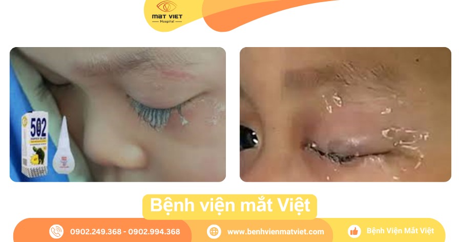 Da mi – bờ mi dính keo 502.