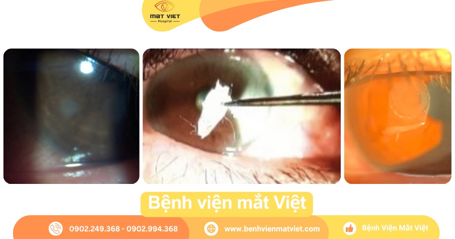 Giác mạc bị keo 502 bắn vào mắt.