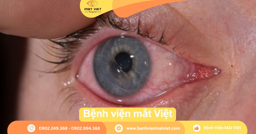 Rách giác mạc.