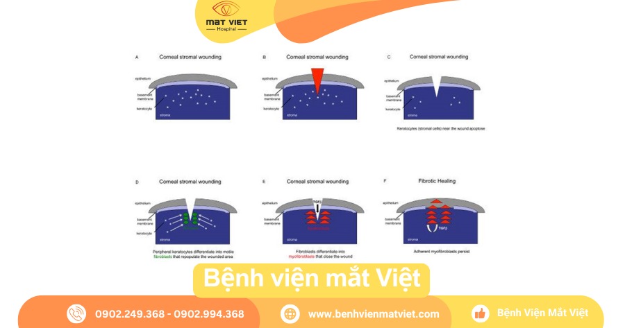 Quá trình lành vết rách sâu phần nhu mô giác mạc.