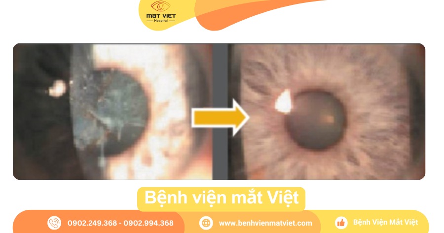 Sẹo giác mạc và giác mạc sau khi điều trị bằng laser PTK