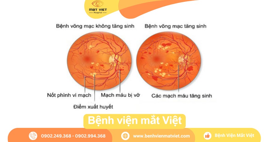 Hình ảnh bệnh võng mạc đái tháo đường