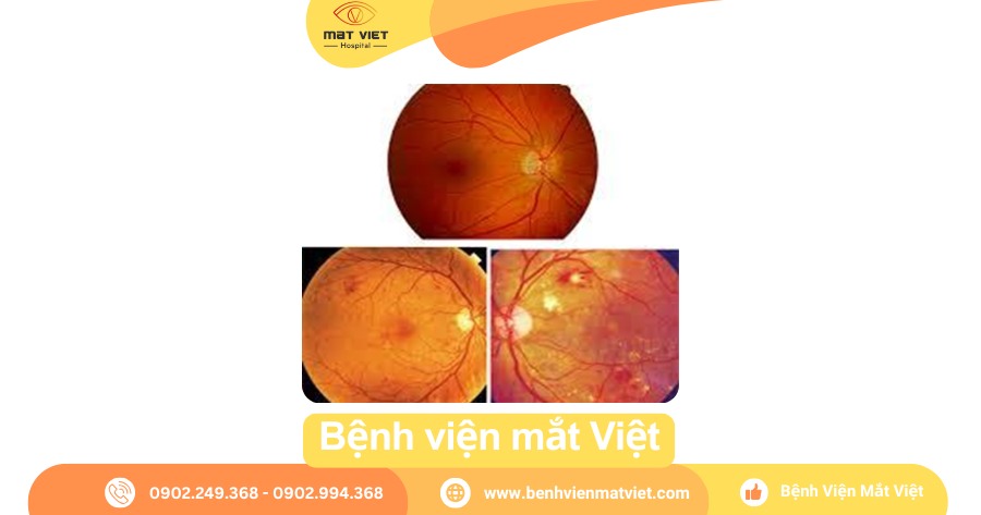 Hình ảnh tổn thương võng mạc do tăng huyết áp.