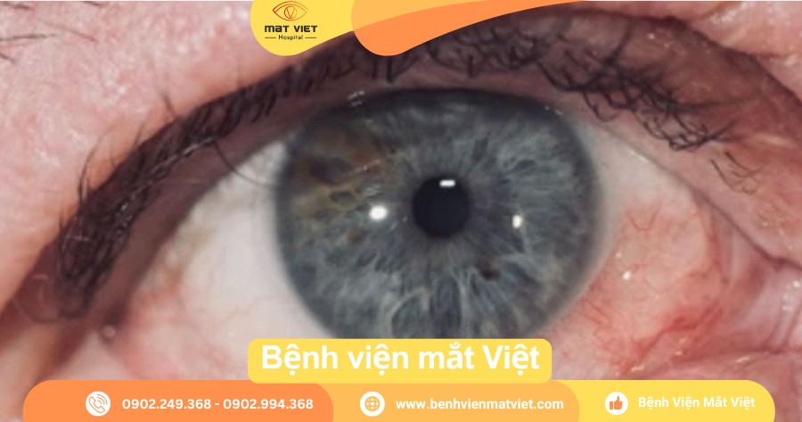 Lông xiêu (Trichiasis) mi trên và mi dưới