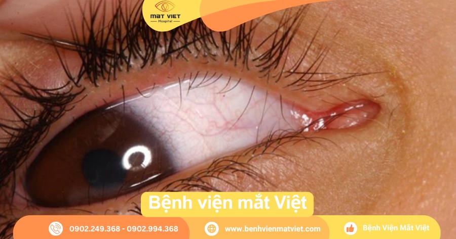 Hàng lông mi phụ (Distichiasis) ở mi trên và mi dưới.