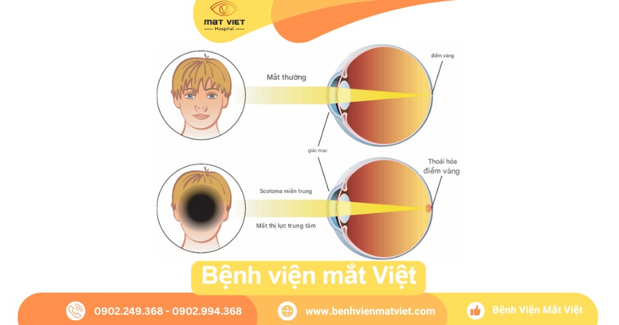 Ám điểm trung tâm (Central scotoma)