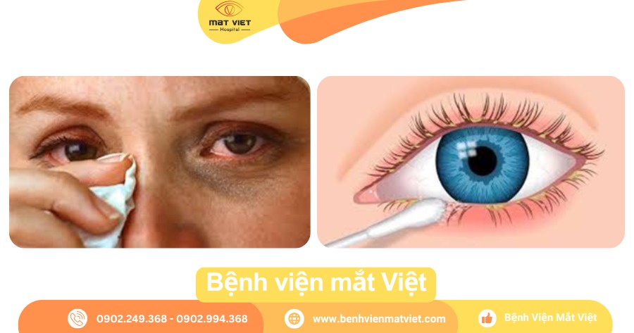 Hình: Vệ sinh mắt bị ghèn.